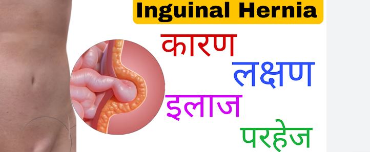 Home Remedies Inguinal Hernia In Hindi